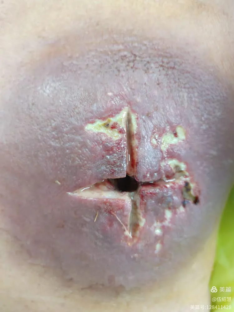 抗炎1周后切口仍有分泌物,考虑切口过小,引流不畅早期切开排脓并给予